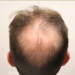 This is an FUE hair transplant surgery into the crown by Dr. Yazdan