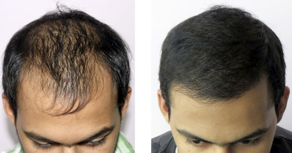 B12 and facial hair growth