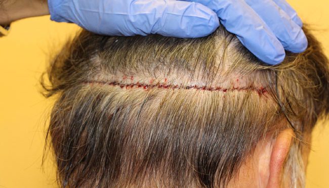 3 Ways to Deal with a Hair Transplant at Work