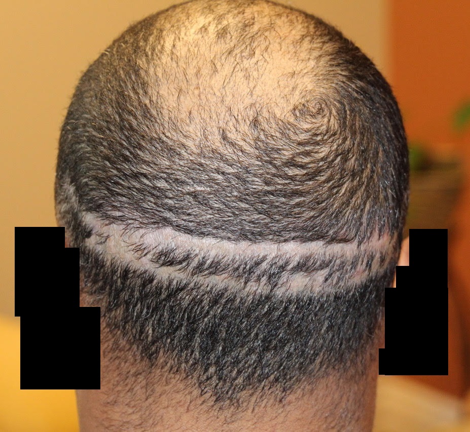 Case Study - Botched Strip FUT Hair Transplant Surgery Repaired By Dr ...