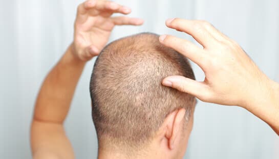 Do you have folliculitis hair loss? - Modena Hair Institute