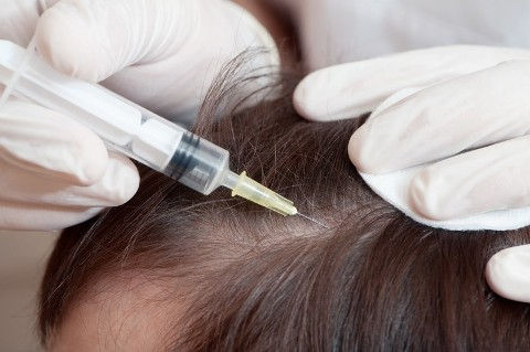 Steroid injections for hair loss