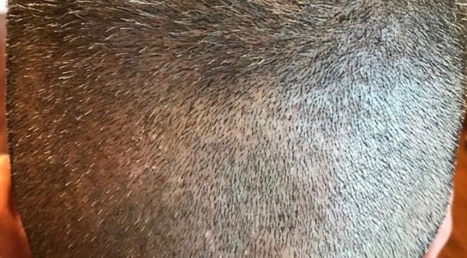 Is my donor area sufficient for hair transplantation?