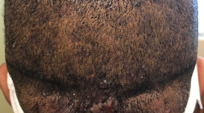 Case Study – Botched Strip Scar Repaired by FUE