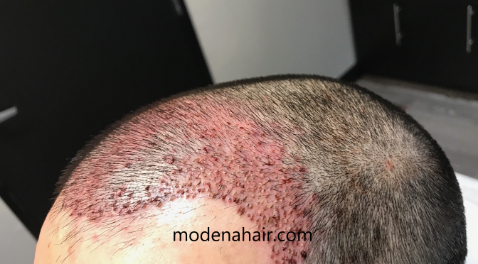 Case Study – FUE Receding Hairline Restoration Transplant