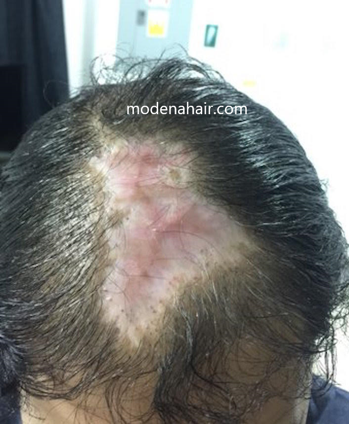 Turkey hair transplant surgery gone wrong - Modena Hair Institute