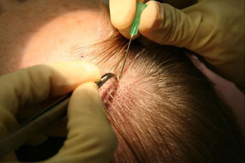 How Many FUE Grafts Do I Need For My Hair Transplant Surgery?