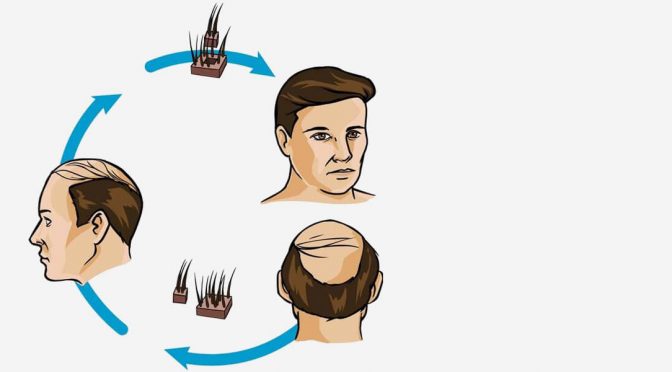 FUE Hair Transplant: How Long Will It Take For My Hair To Regrow?