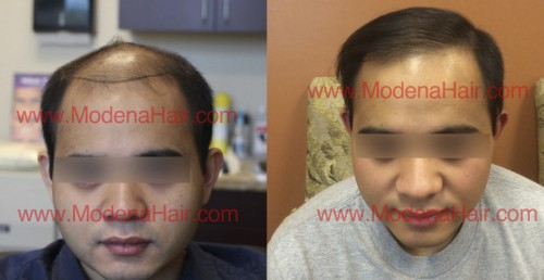 Asians: How Ethnicity Plays a Role in Hair Transplants