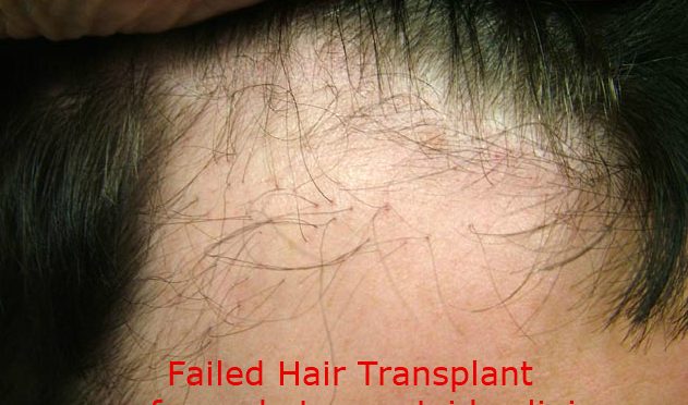 I Had a FAILED Hair Transplant: What Do I Do Next?