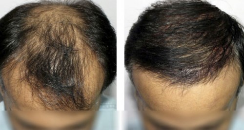 Middle Easterners: How Ethnicity Plays a Role in Hair Transplants