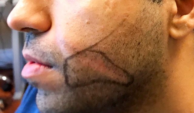 Case Study – Facial Scar Repair via FUE from Dog Bite