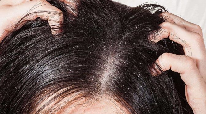 Which One of These is Causing Your Scalp Irritation?