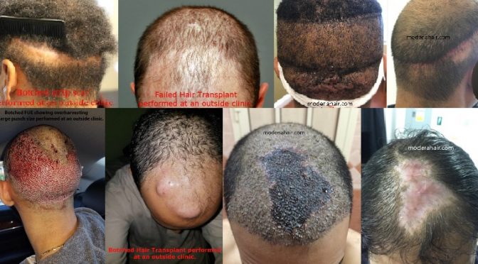 Buyer Beware: Warning of Unlicensed Hair Restoration Services