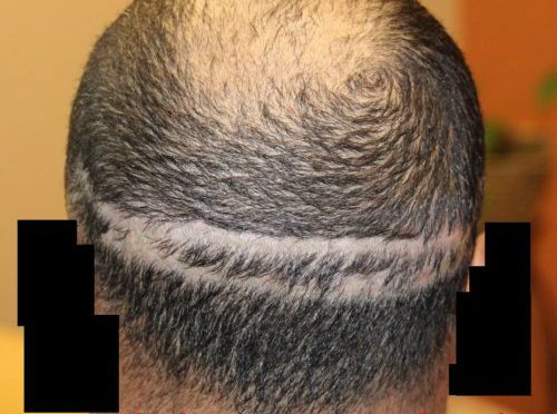 The Truth About Commercial Hair Transplant Clinics