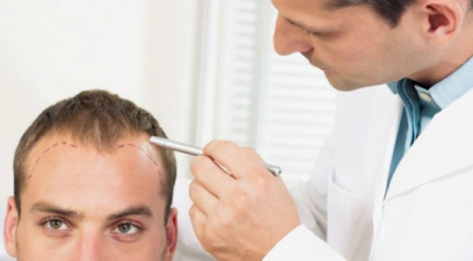 Are FUE Procedures Safe? It Depends on Your Doctor