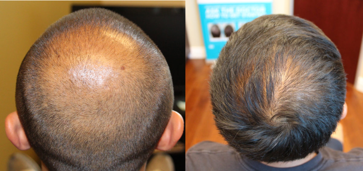 Hair Transplants for a Thinning Crown