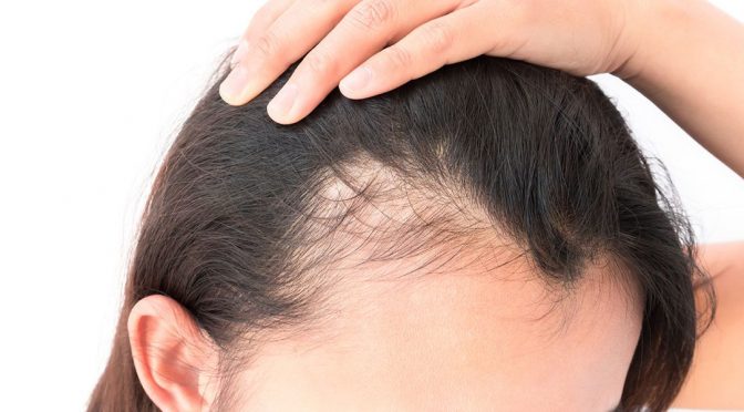 The Greatest New Treatment for Thinning Hair in Women: PRP Therapy