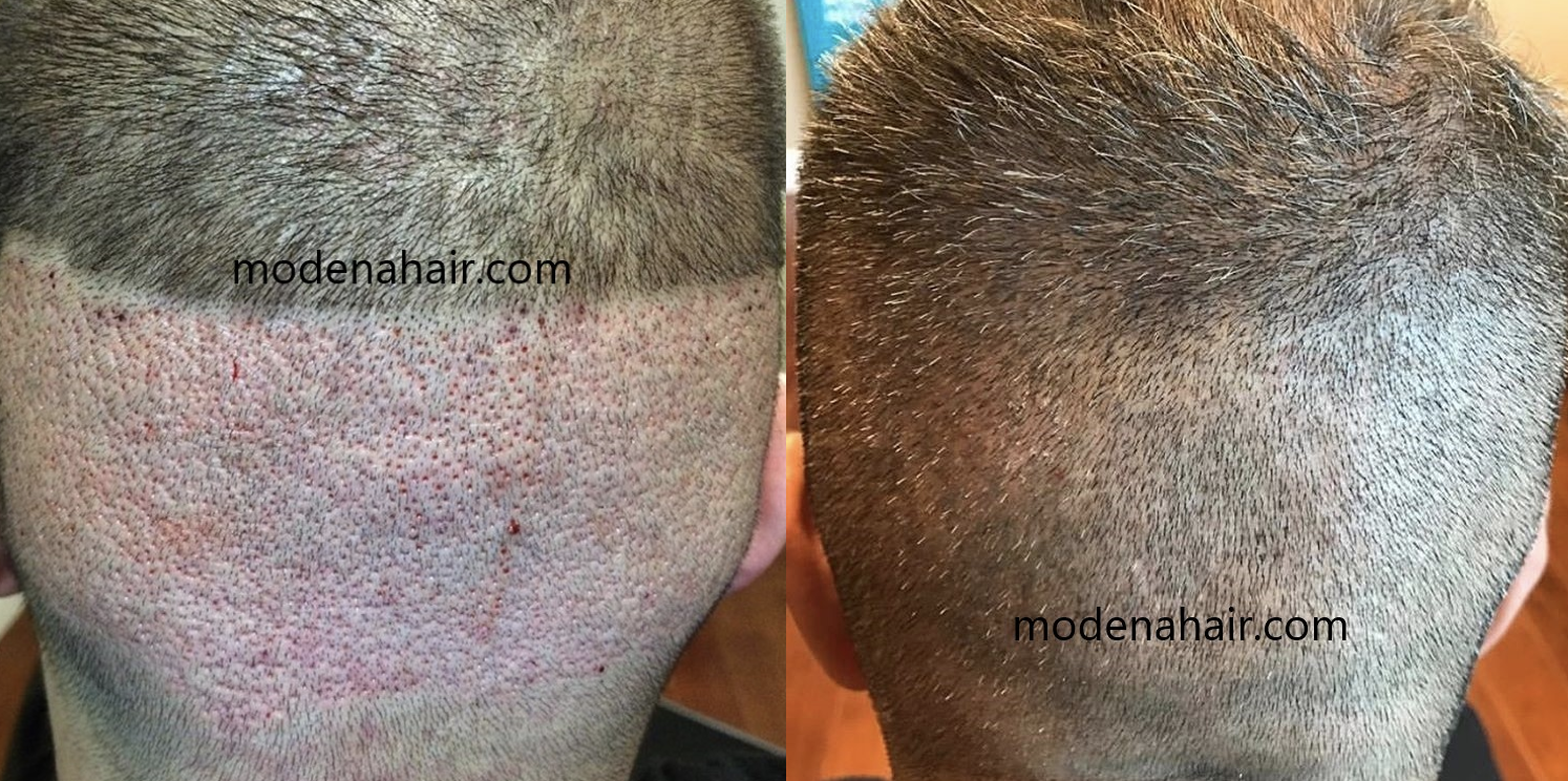 A Complete Guide to Hair Transplantation Scarring - Modena Hair Institute