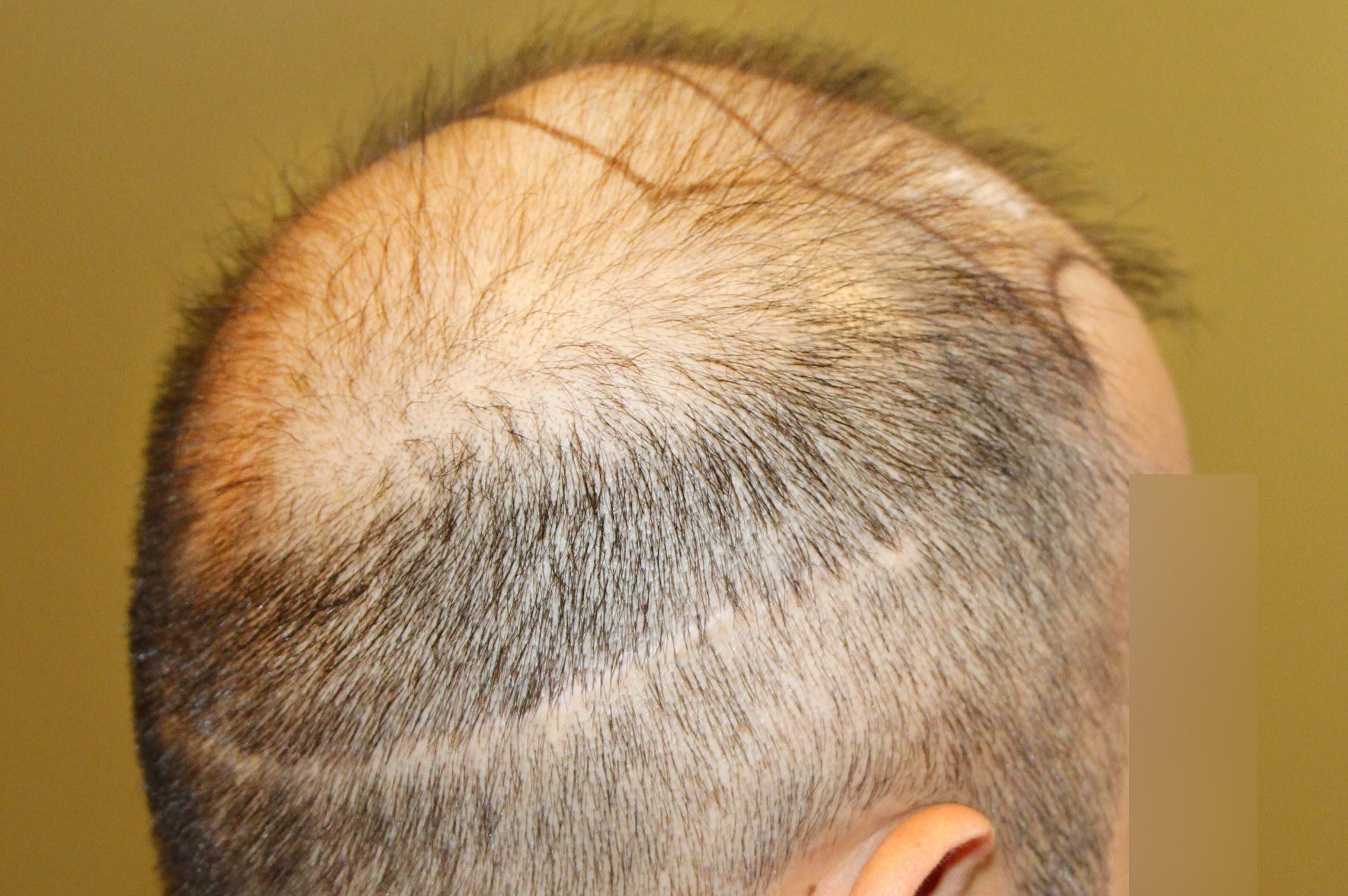 Seven Signs You're in The Wrong Hair Restoration Clinic