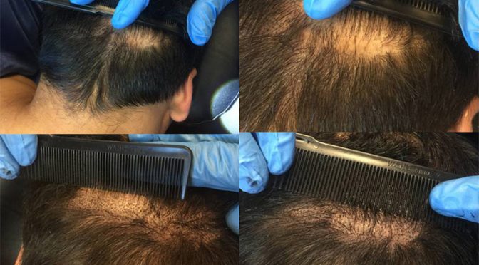 How to Conceal Hair Transplant Scars