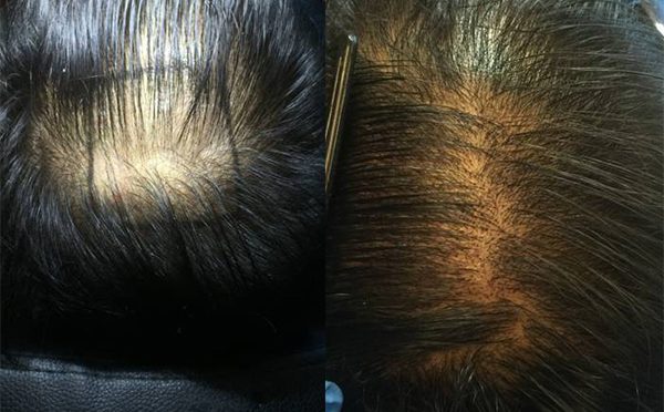 Achieving the Right Density During your Hair Transplant