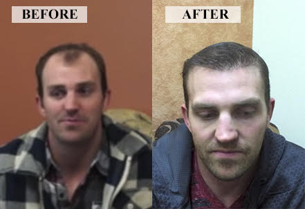 I Got a Hair Transplant at 29 - Here's What to Expect When Getting a New Hairline - Modena Hair Institute I Got a Hair Transplant at 29 - Here's What to Expect When Getting a New Hairline - Modena Hair Institute