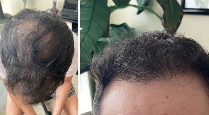 Male Hair Loss Success Story: “I came in with low expectations but the results have been incredible”