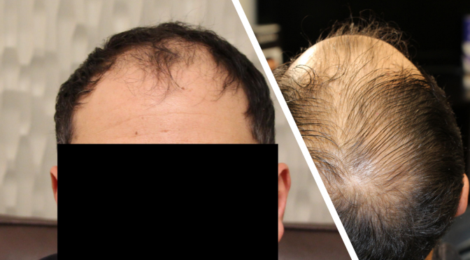 Restoring Crown Hair Requires a Highly Skilled Surgeon