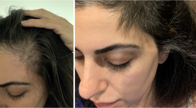Female Hair Loss Success Story: PRP Hair Restoration Following Pregnancy