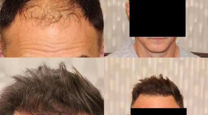 Male Hair Transplant Repair Success Story
