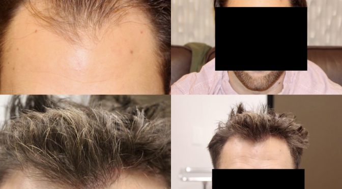 Male Hair Transplant Repair Success Story – 02/01/2021