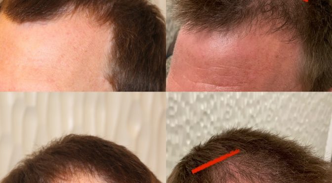 34 yr old male FUE – Filling in Hairline – 1517 Grafts