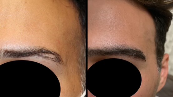 Eyebrow Hair Restoration Case Study