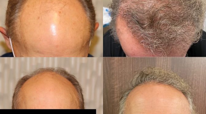 Norwood 7 Hair Restoration –  59 year old – 3,700 Grafts