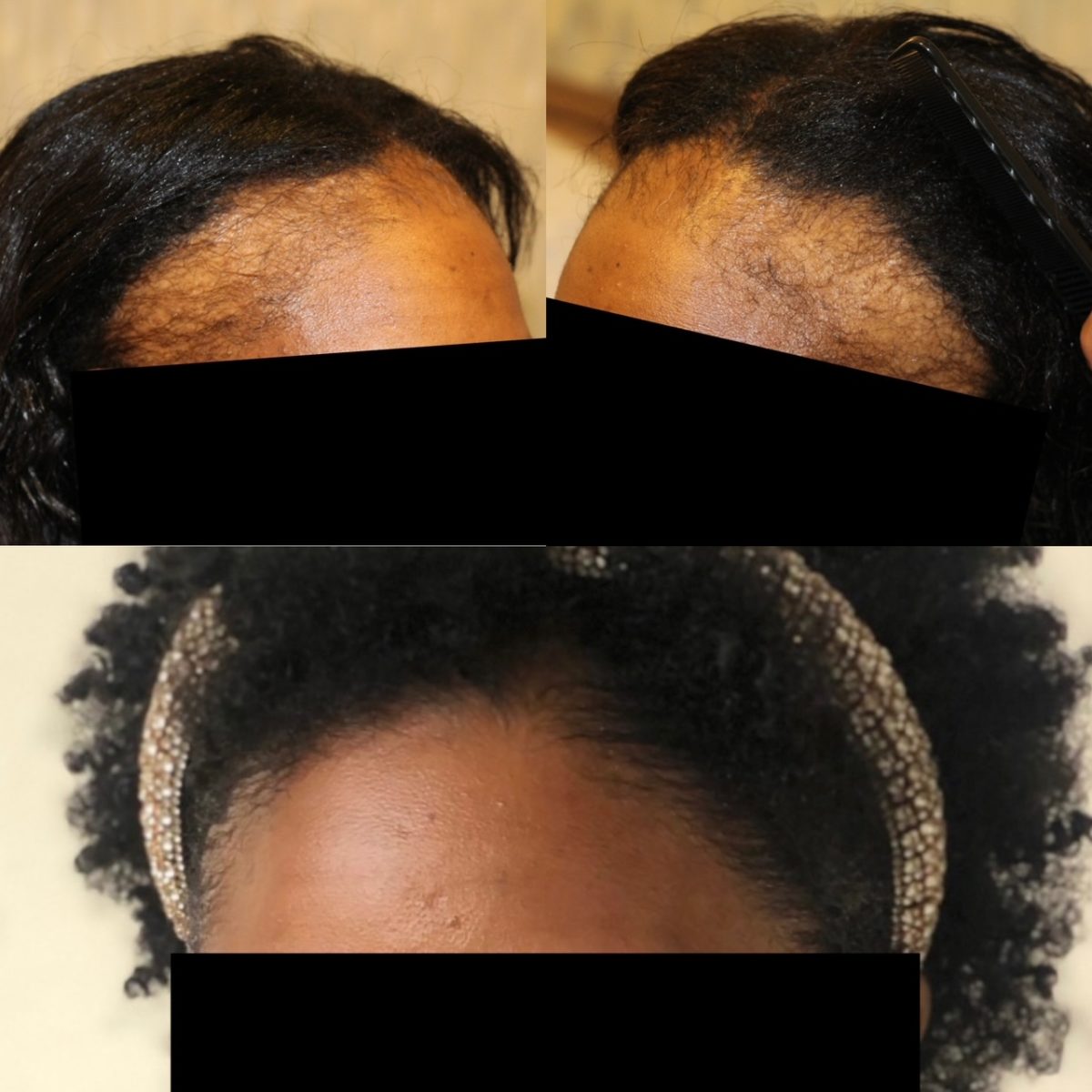 African American Female Hair Restoration Before and After