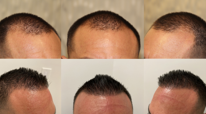 Small Punch FUE – 40yr Old Male