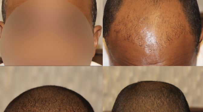 FUE Repair – False Claims Made to Patient