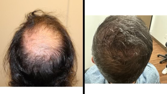 32 Yr. Male Crown Hair Transplant