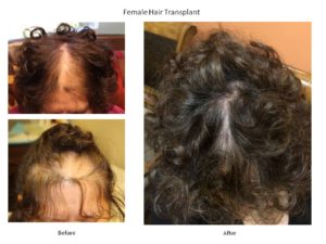 menopause hair thinning
