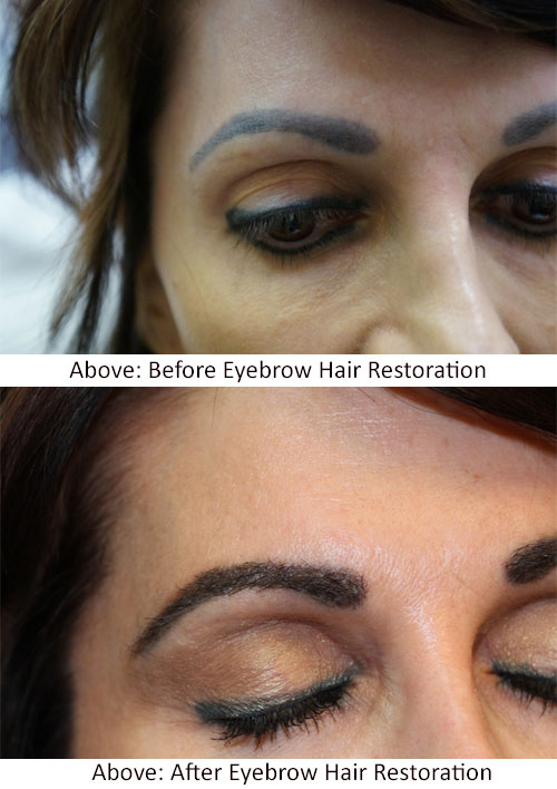eyebrow hair restoration