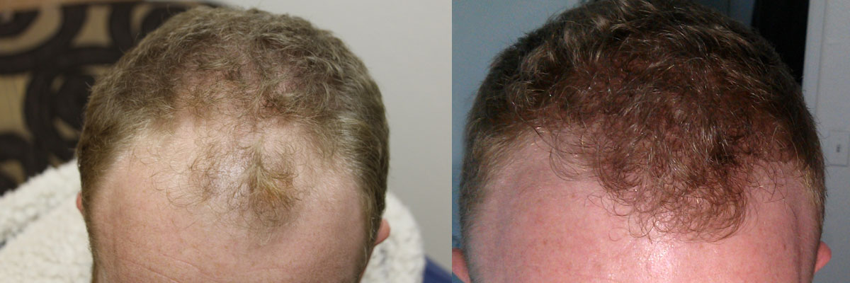 fue hair transplant