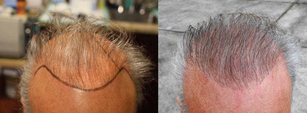 Hair Transplant Repair with Beard & Chest Hair | Orange County, CA