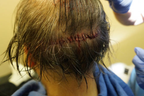 Fig. 1 - Poor donor closure technique.