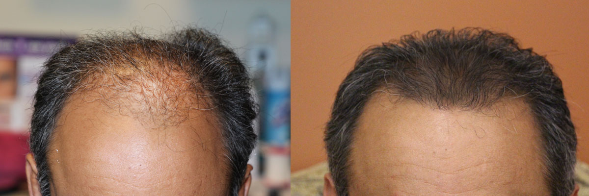 fue hair transplant 2000 grafts