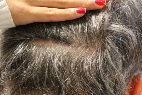 Fig. 3 - 6 months after closure and wound is barely visible.