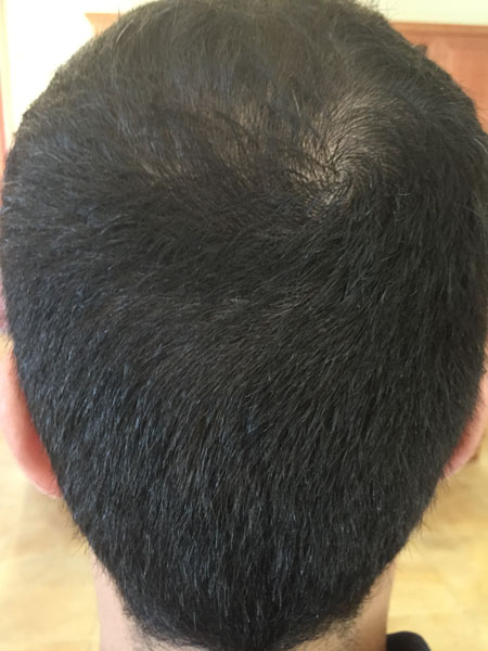 Donor area 30 days post FUE Hair Transplant by Dr. Yazdan.