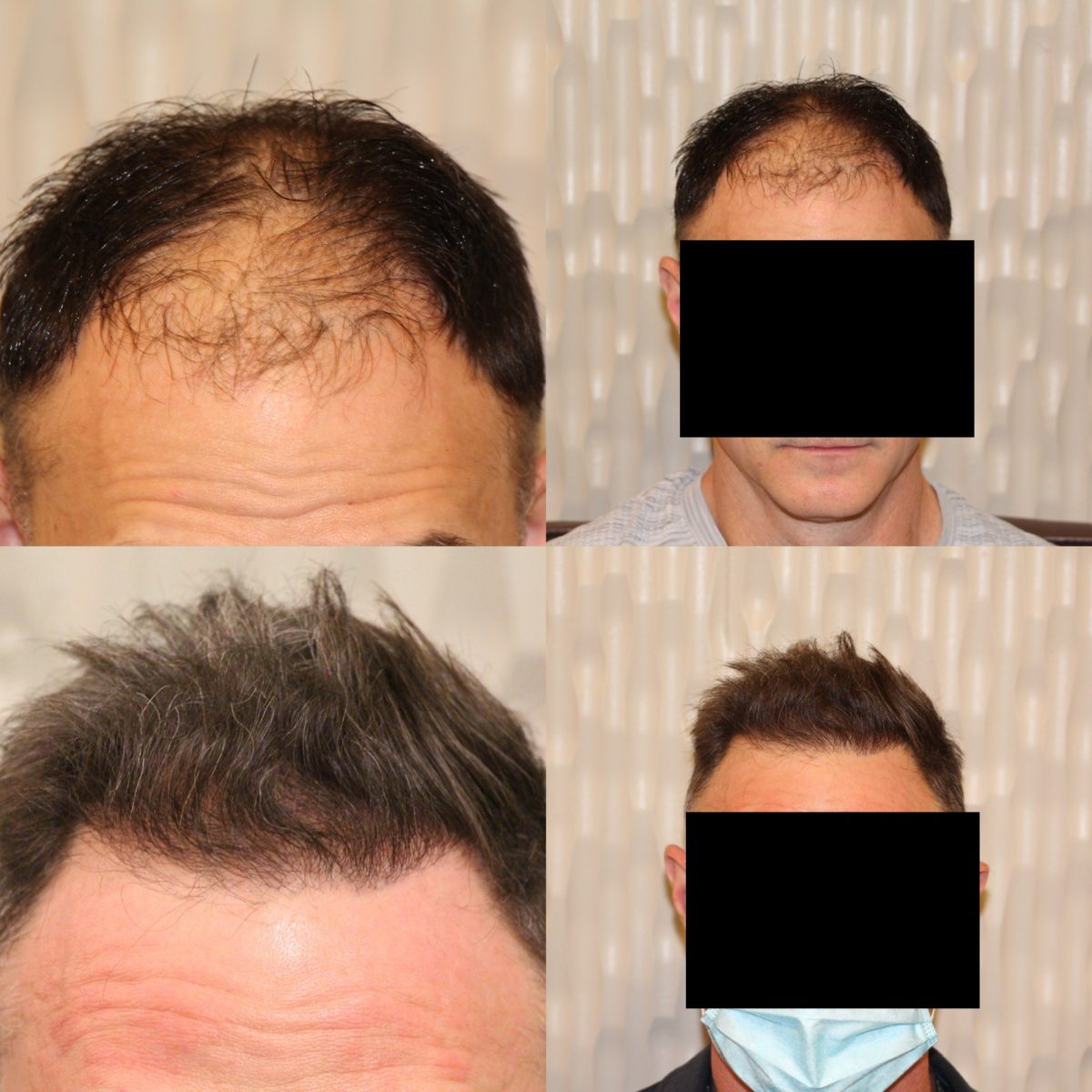 Male Hair Transplant Repair Success Story