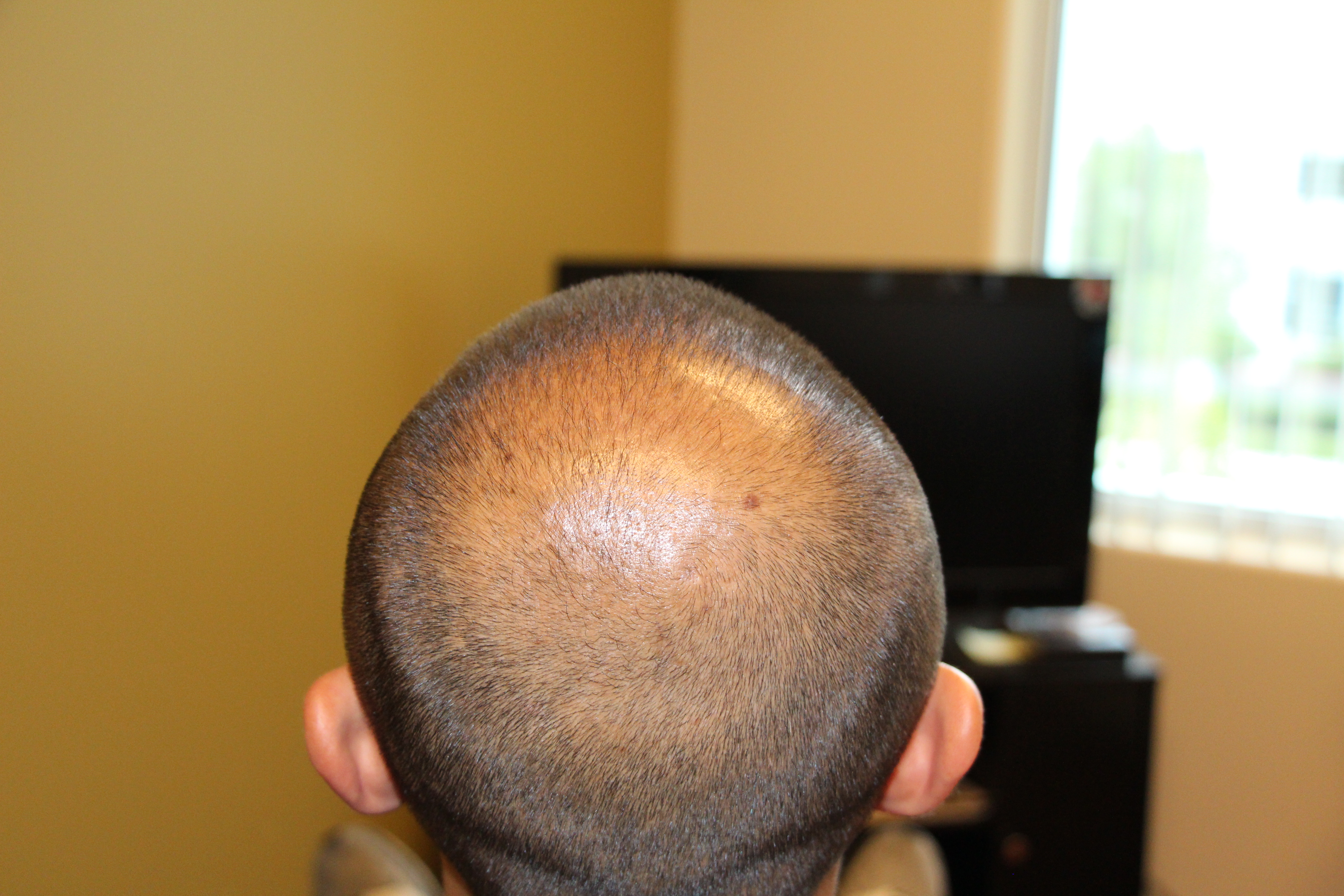 Case Study FUE Crown Hair Transplant Modena Hair Institute