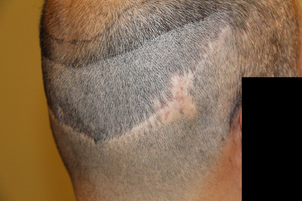 Botched hair transplant surgeries continue to rise Botched hair transplant surgeries continue to rise